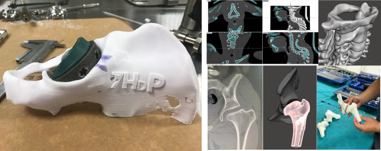 Orthopaedic 3d Printing Lab Dr Rudolph Venter